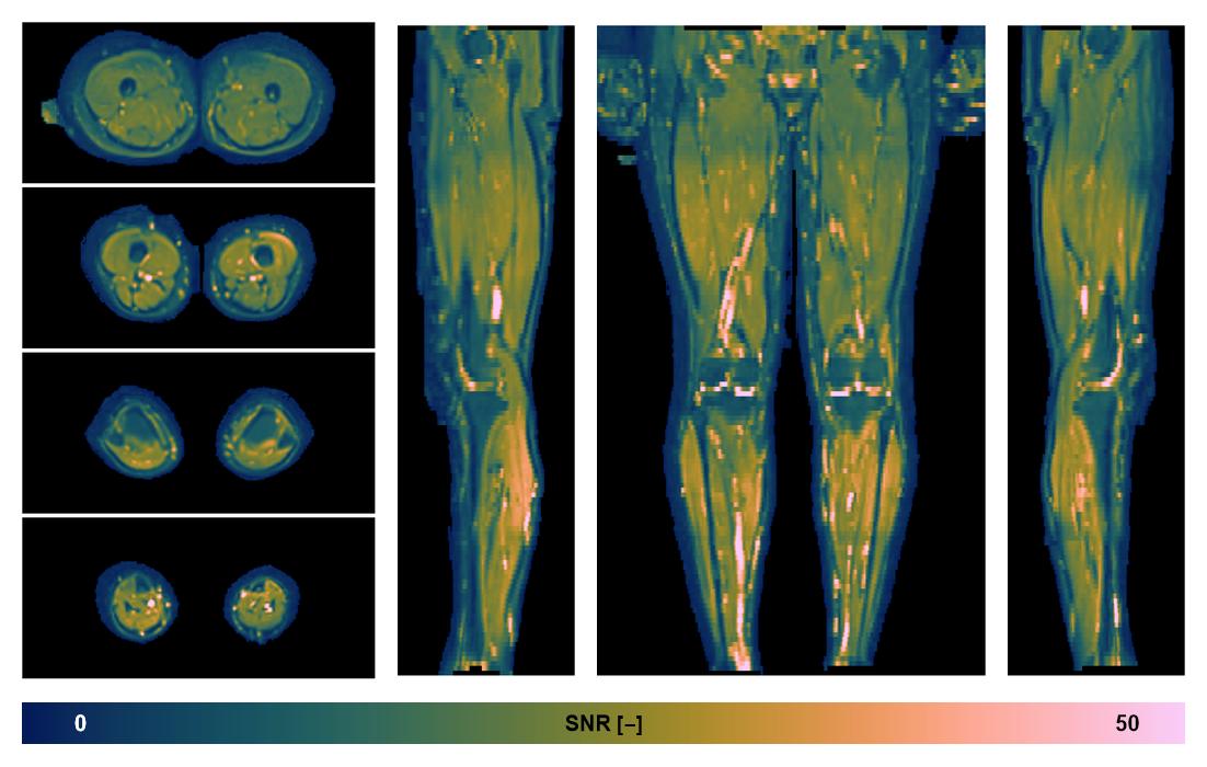 SNR distribution of the unweighted diffusion data.